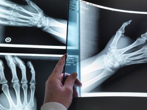 Doctors hand holding up hand xray in hospital